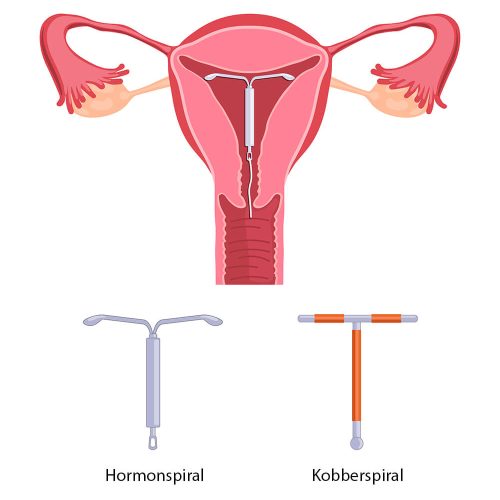 Hormonspiral i Oslo sentrum hos gynekolog