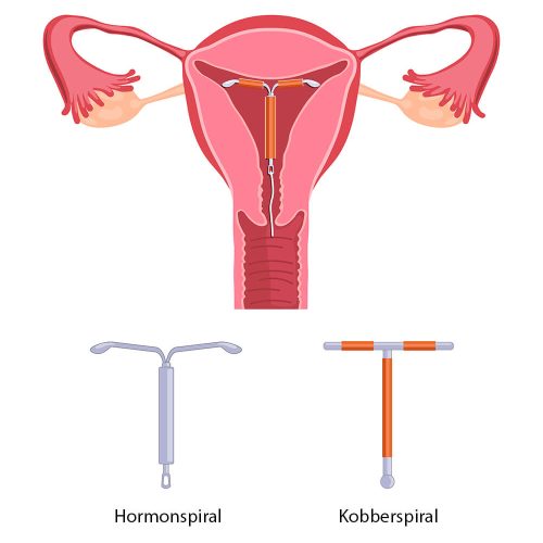 Kobberspiral i Oslo sentrum hos gynekolog