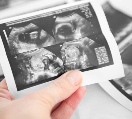 Tidlig ultralyd hos gynekolog